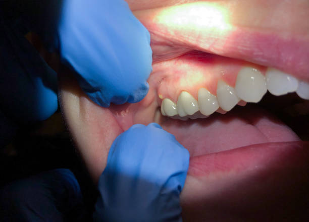 Best Knocked-Out Tooth Emergency  in La Harpe, IL